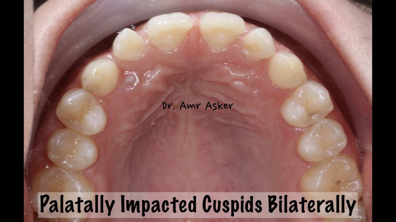 Bilateral palatally impacted canines image